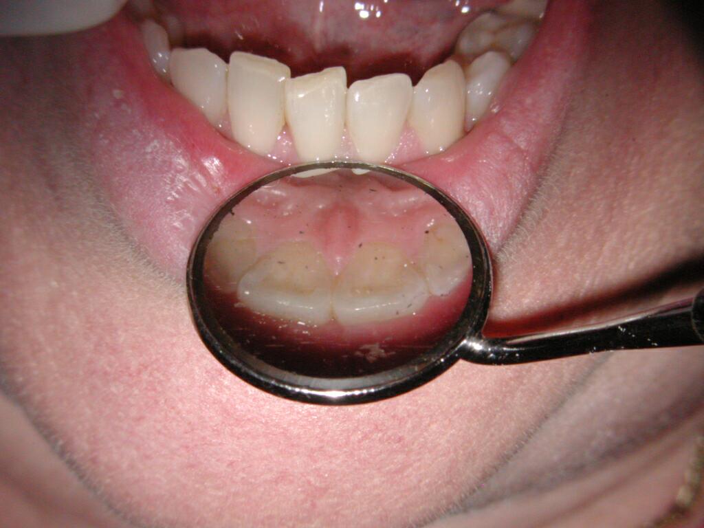 Upper Incisor at lower incisors 2 .jpg
